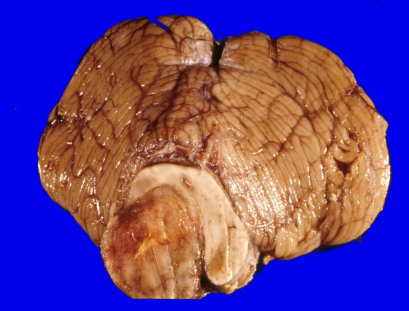 8A1 Glioblastoma (Case 8) WM