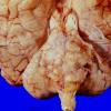 9A1 Glioblastoma, brainstem (Case 9) A