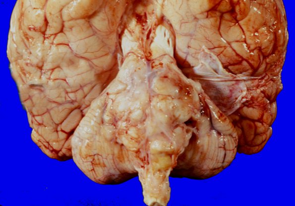 9A1 Glioblastoma, brainstem (Case 9) A