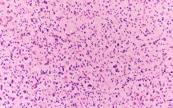 9B1 Glioblastoma, brainstem (Case 9) H&E 20X