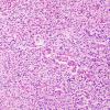 9B2 Glioblastoma, brainstem (Case 9) H&E 10X