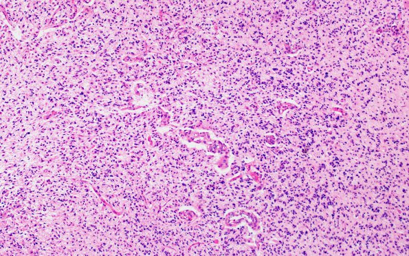 9B2 Glioblastoma, brainstem (Case 9) H&E 10X