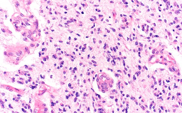 9B3 Glioblastoma, brainstem (Case 9) H&E 40X