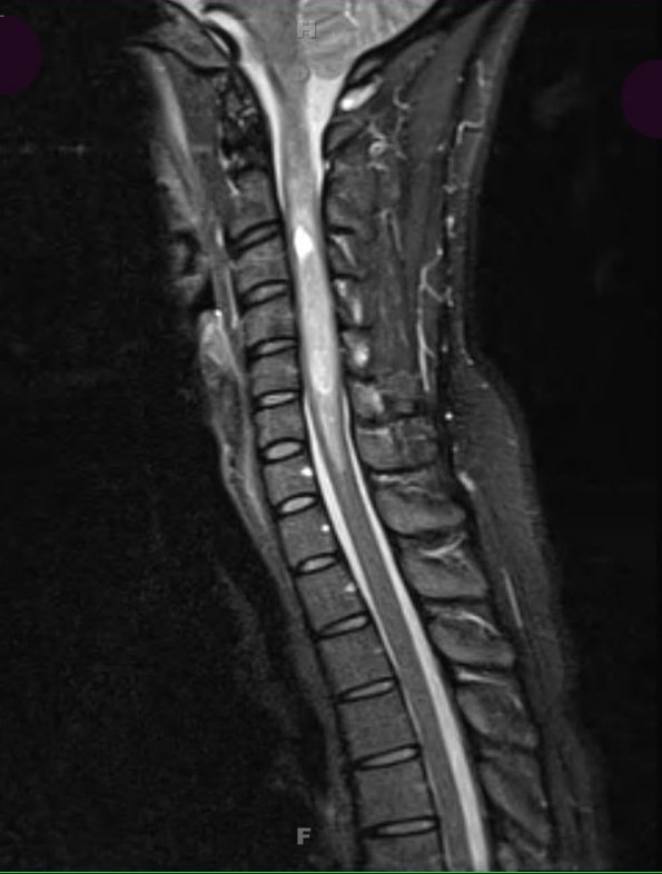 1A1 Ependymoma (Case 1) STIR - Copy