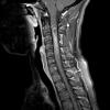 1A2 Ependymoma (Case 1) T1 W 2 - Copy