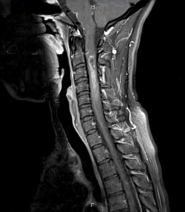 1A2 Ependymoma (Case 1) T1 W 2 - Copy