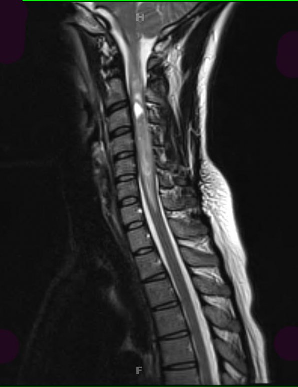 1A3 Ependymoma (Case 1) T2 - Copy