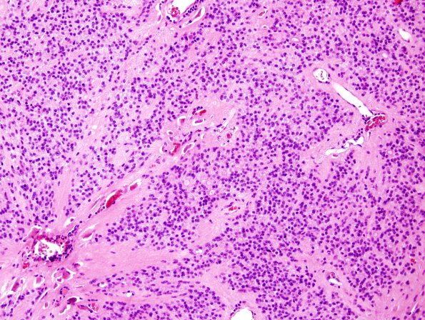 1B1 Ependymoma (Case 1) H&E 10