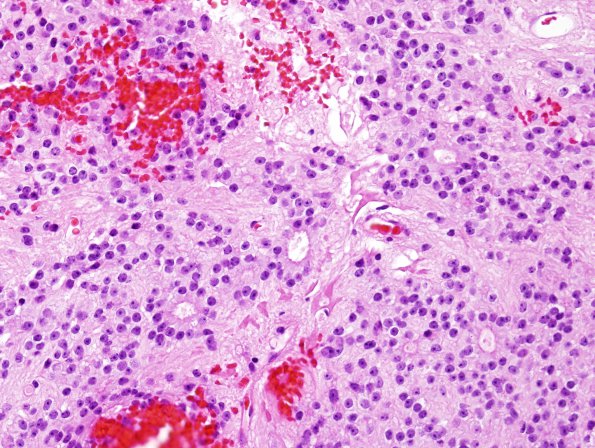 1B2 Ependymoma (Case 1) H&E 9