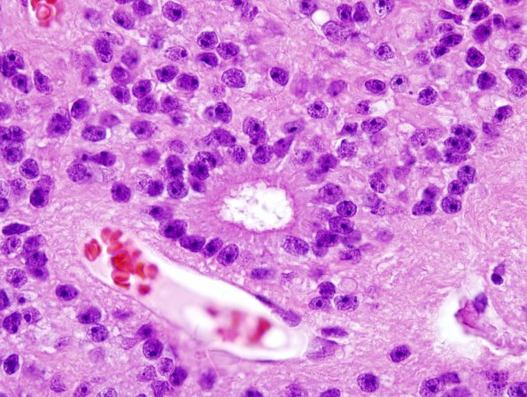 1B3 Ependymoma (Case 1) H&E 8