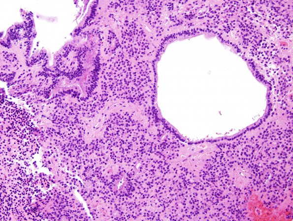 1B4 Ependymoma (Case 1) H&E 4