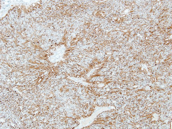 1C Ependymoma (Case 1) GFAP 1