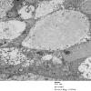 1E1 Ependymoma (Case 1)_037 - Copy