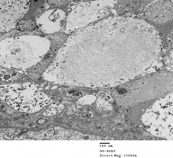 1E1 Ependymoma (Case 1)_037 - Copy