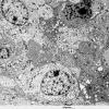 1E2 Ependymoma (Case 1)_033 - Copy