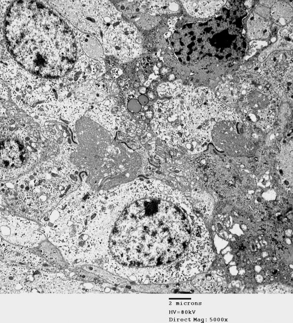 1E2 Ependymoma (Case 1)_033 - Copy