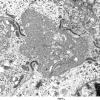 1E3 Ependymoma (Case 1)_034 - Copy