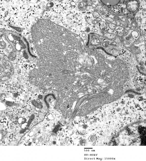 1E3 Ependymoma (Case 1)_034 - Copy