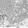 1E4 Ependymoma (Case 1)_035 copy - Copy