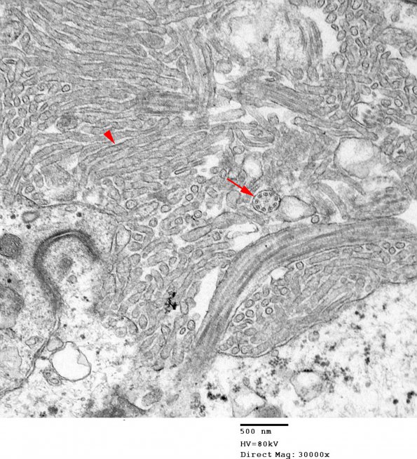 1E4 Ependymoma (Case 1)_035 copy - Copy