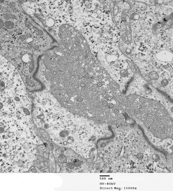 1E6 Ependymoma (Case 1)_028 - Copy