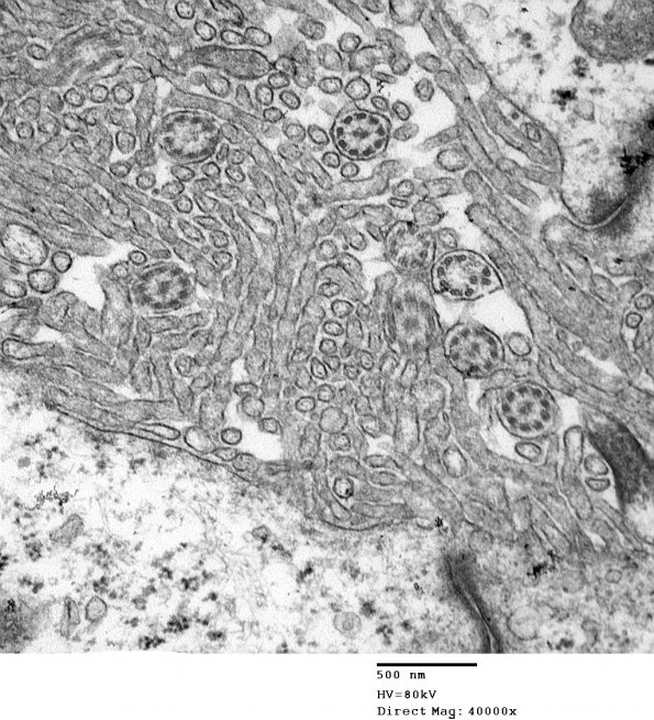 1E7 Ependymoma (Case 1)_027 - Copy