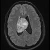 2A1 Ependymoma (Case 2) FLAIR - Copy