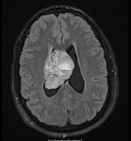 2A1 Ependymoma (Case 2) FLAIR - Copy