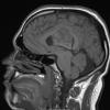 2A2 Ependymoma (Case 2) T1 - Copy