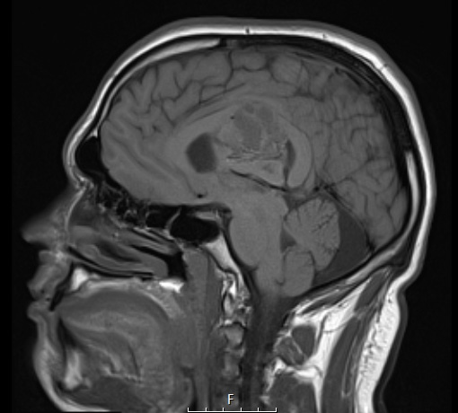 2A2 Ependymoma (Case 2) T1 - Copy