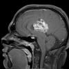 2A3 Ependymoma (Case 2) T1W - Copy