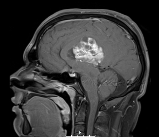 2A3 Ependymoma (Case 2) T1W - Copy