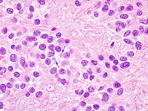 2B1 Ependymoma (Case 2) H&E 100X 4 copy