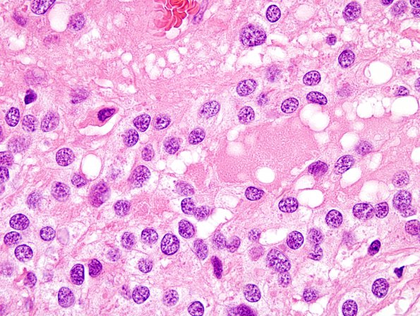 2B2 Ependymoma (Case 2) H&E 100X 6