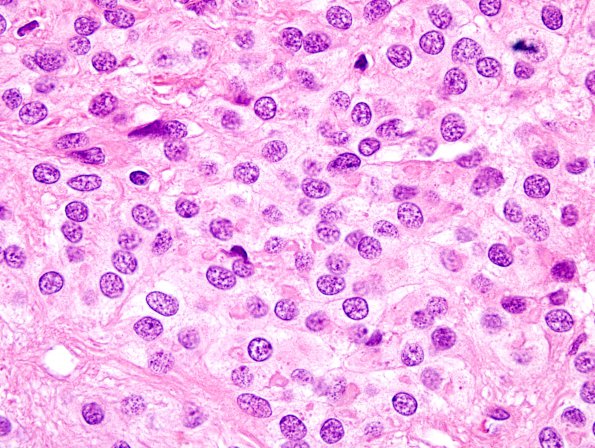 2B3 Ependymoma (Case 2) H&E 100X 11