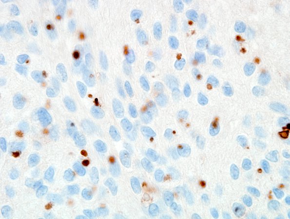 2C Ependymoma (Case 2) EMA 100X 1