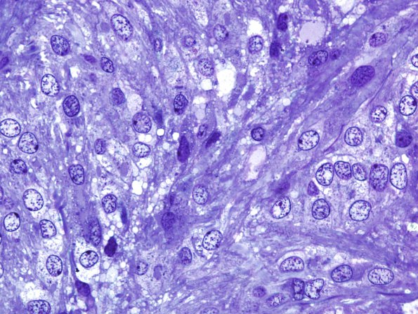 2D2 Ependymoma (Case 2) -15