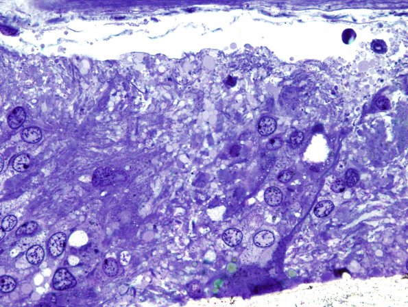 2D3 Ependymoma (Case 2) 16