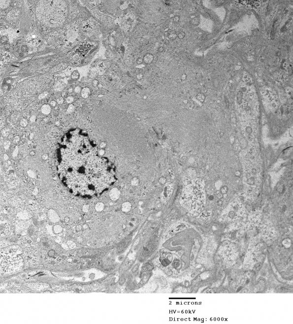 2E1 Ependymoma (Case 2) EM 043 - Copy