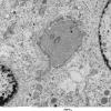 2E10 Ependymoma (Case 2) EM 012 - Copy