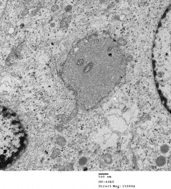 2E10 Ependymoma (Case 2) EM 012 - Copy