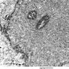 2E11 Ependymoma (Case 2) EM 010 - Copy