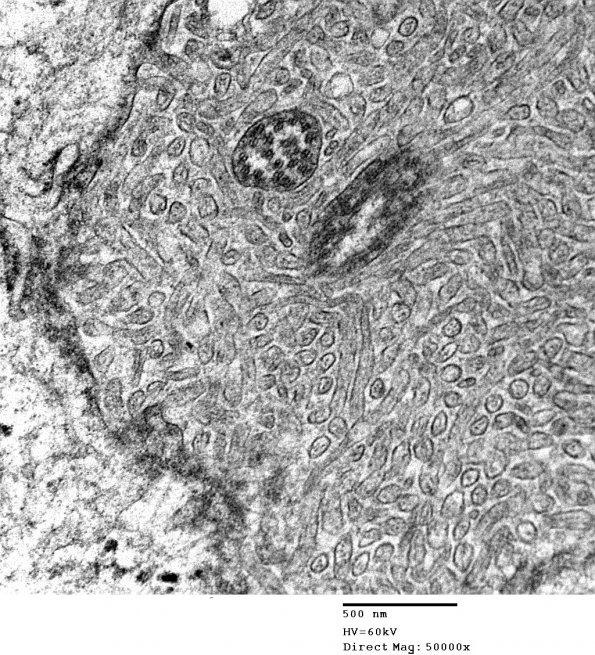 2E11 Ependymoma (Case 2) EM 010 - Copy