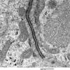 2E12 Ependymoma (Case 2) EM 019 - Copy