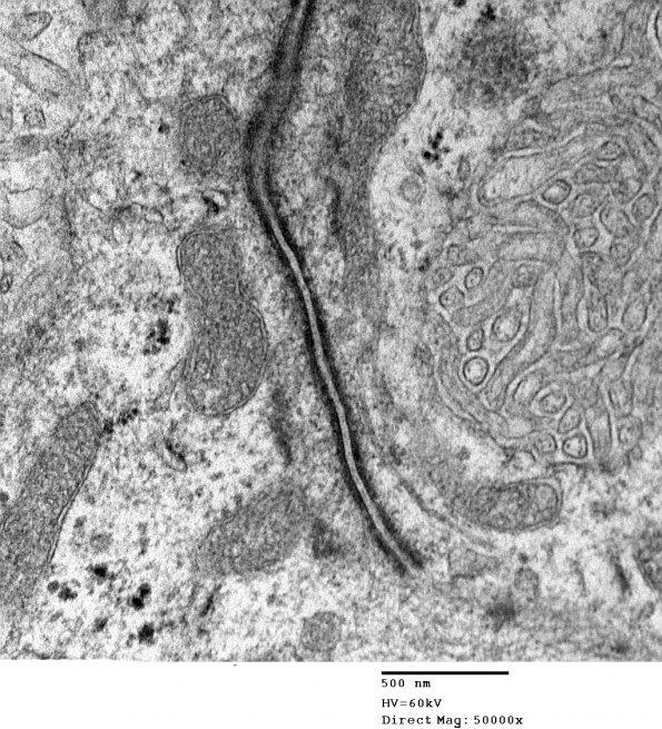 2E12 Ependymoma (Case 2) EM 019 - Copy