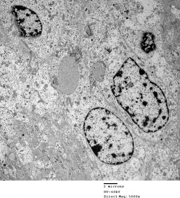 2E13 Ependymoma (Case 2) EM 027 - Copy