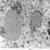 2E14 Ependymoma (Case 2) EM 030 - Copy