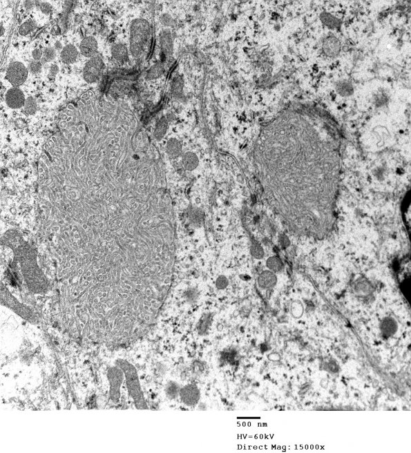 2E14 Ependymoma (Case 2) EM 030 - Copy