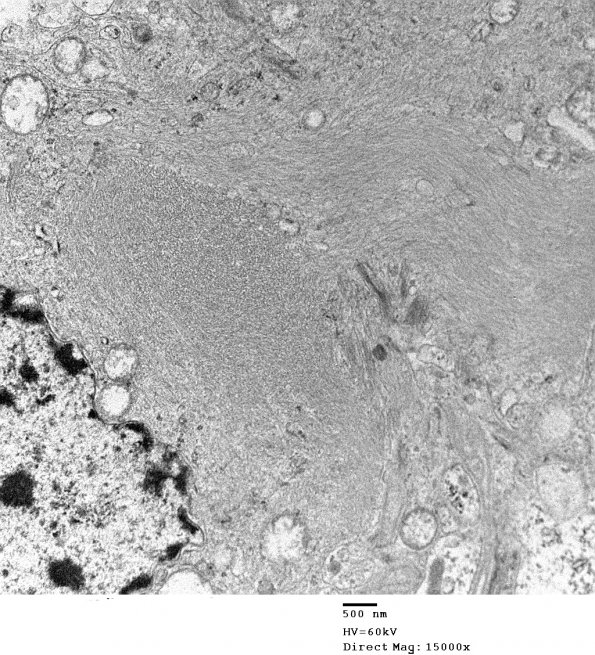 2E2 Ependymoma (Case 2) EM 044 - Copy