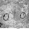 2E3 Ependymoma (Case 2) EM 003 - Copy